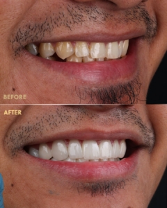 Ảnh sau khi dán sứ veneer